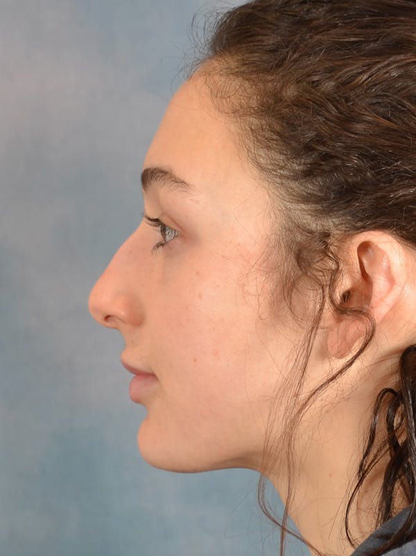 Rhinoplasty Before & After Gallery - Patient 148257069 - Image 1