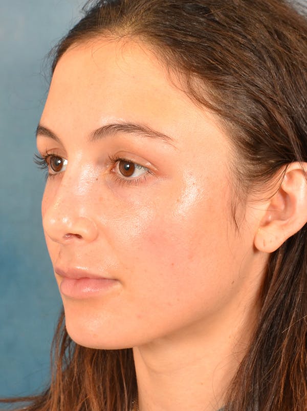 Rhinoplasty Before & After Gallery - Patient 148257069 - Image 10