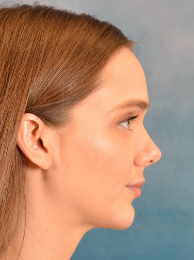 Chin Augmentation Before & After Gallery - Patient 146208577 - Image 6