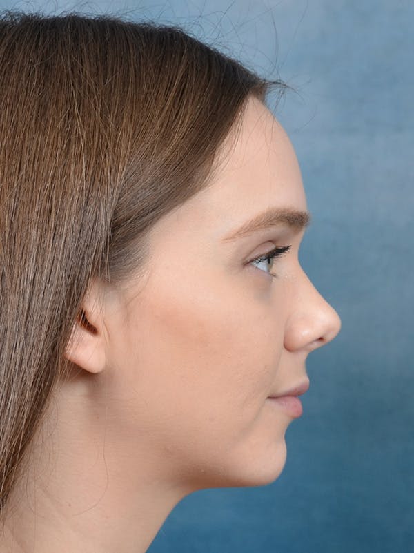Chin Augmentation Before & After Gallery - Patient 146208577 - Image 5