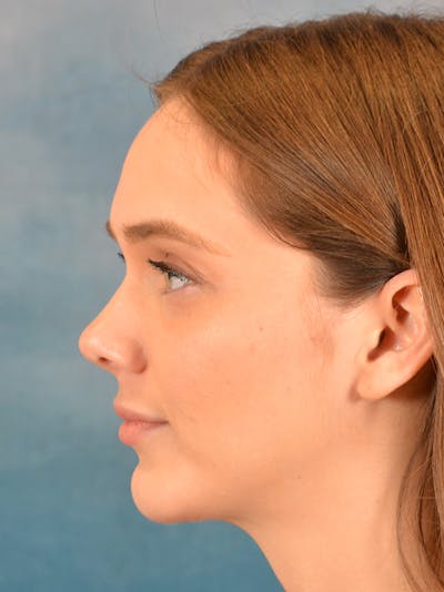 Chin Augmentation Before & After Gallery - Patient 146208577 - Image 10