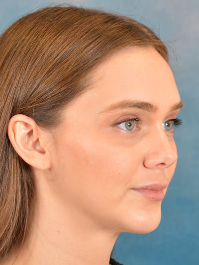 Chin Augmentation Before & After Gallery - Patient 146208577 - Image 4