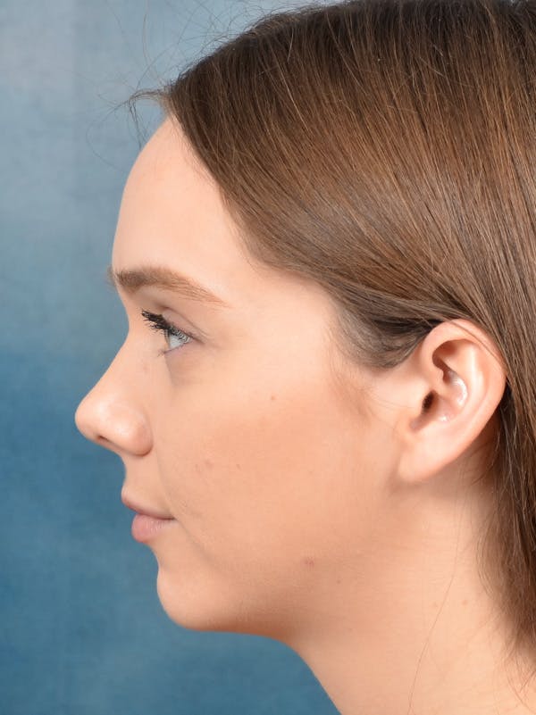 Chin Augmentation Before & After Gallery - Patient 146208577 - Image 9