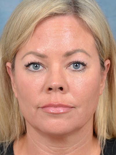 Eyelid Lift Before & After Gallery - Patient 148827543 - Image 1