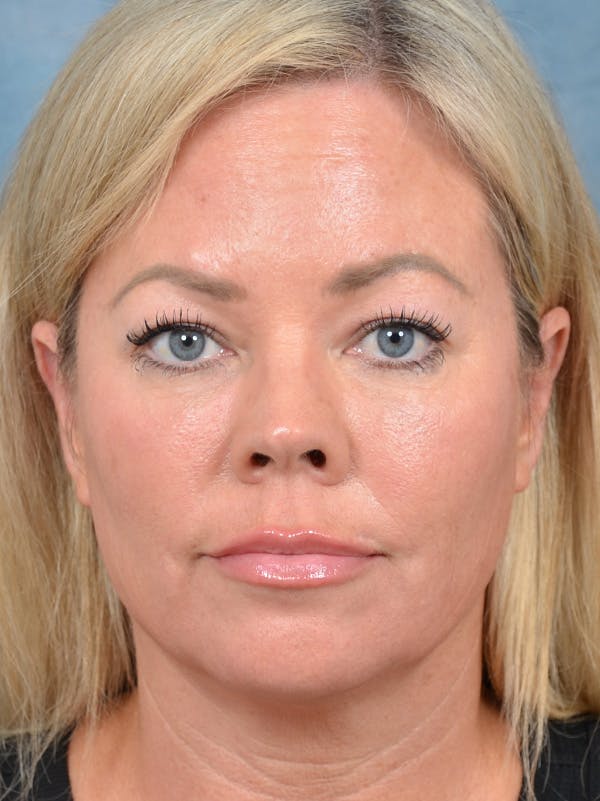 Deep Plane Facelift Before & After Gallery - Patient 148827429 - Image 3