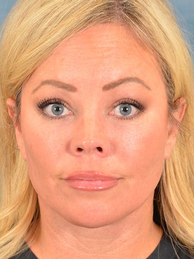 Deep Plane Facelift Before & After Gallery - Patient 148827429 - Image 4