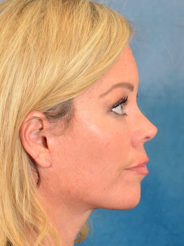Deep Plane Facelift Before & After Gallery - Patient 148072052 - Image 8