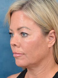 Deep Plane Facelift Before & After Gallery - Patient 148072052 - Image 1