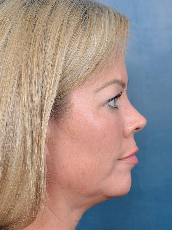 Deep Plane Facelift Before & After Gallery - Patient 148827429 - Image 7