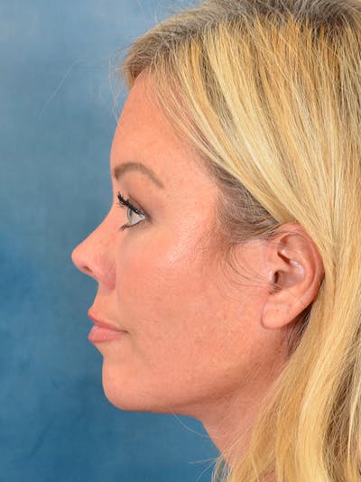 Eyelid Lift Before & After Gallery - Patient 148827543 - Image 10