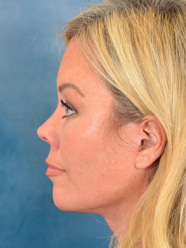 Deep Plane Facelift Before & After Gallery - Patient 148072052 - Image 10