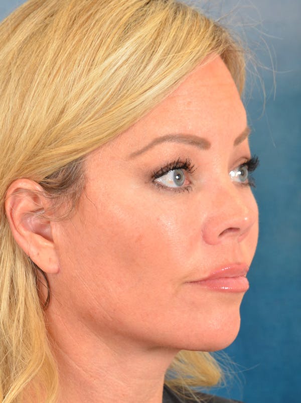 Eyelid Lift Before & After Gallery - Patient 148827543 - Image 6