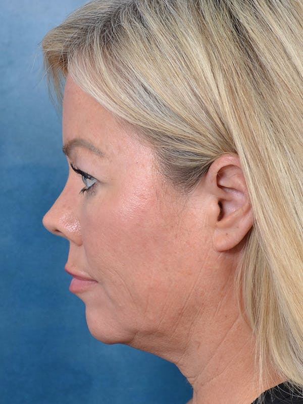 Eyelid Lift Before & After Gallery - Patient 148257057 - Image 9