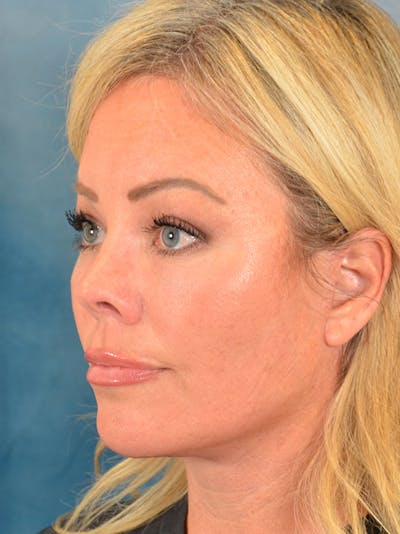 Deep Plane Facelift Before & After Gallery - Patient 148072052 - Image 2
