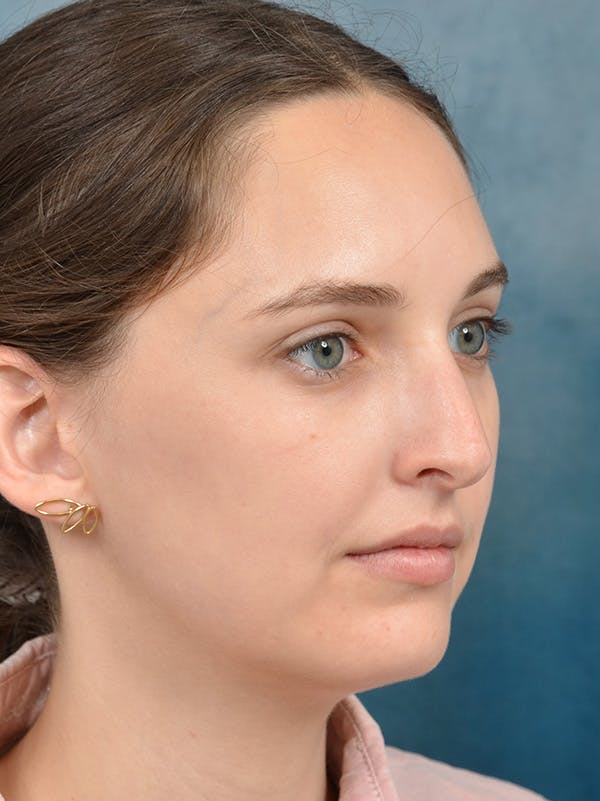Rhinoplasty Before & After Gallery - Patient 148257071 - Image 5