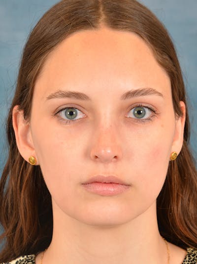 Rhinoplasty Before & After Gallery - Patient 148257071 - Image 4