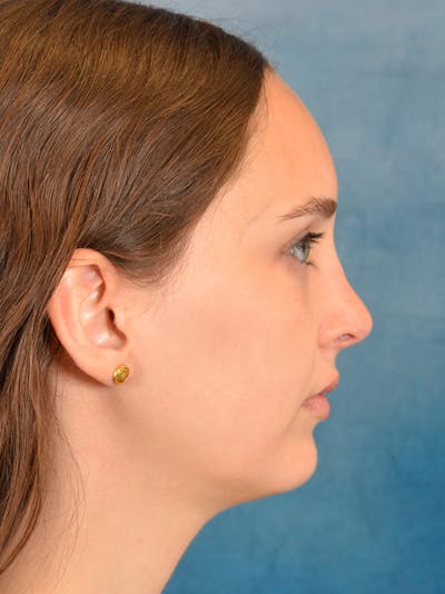 Rhinoplasty Before & After Gallery - Patient 148257071 - Image 8