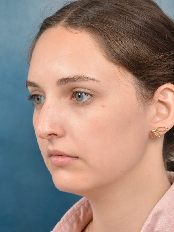 Rhinoplasty Before & After Gallery - Patient 148257071 - Image 9