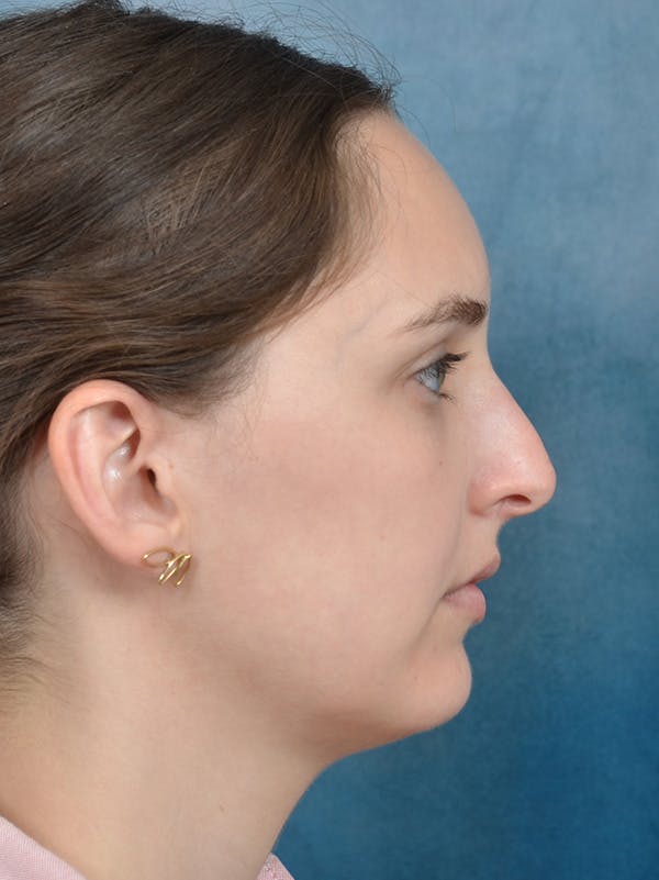 Rhinoplasty Before & After Gallery - Patient 148257071 - Image 7