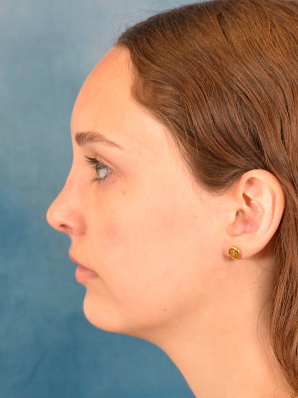 Rhinoplasty Before & After Gallery - Patient 148257071 - Image 2