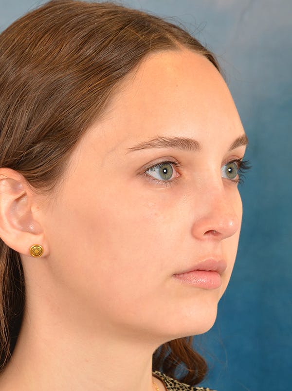 Rhinoplasty Before & After Gallery - Patient 148257071 - Image 6