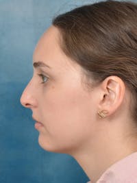 Rhinoplasty Before & After Gallery - Patient 148257071 - Image 1