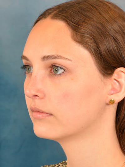 Rhinoplasty Before & After Gallery - Patient 148257071 - Image 10