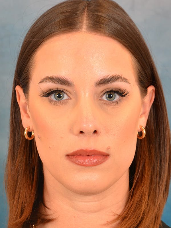 Rhinoplasty Before & After Gallery - Patient 148827476 - Image 4
