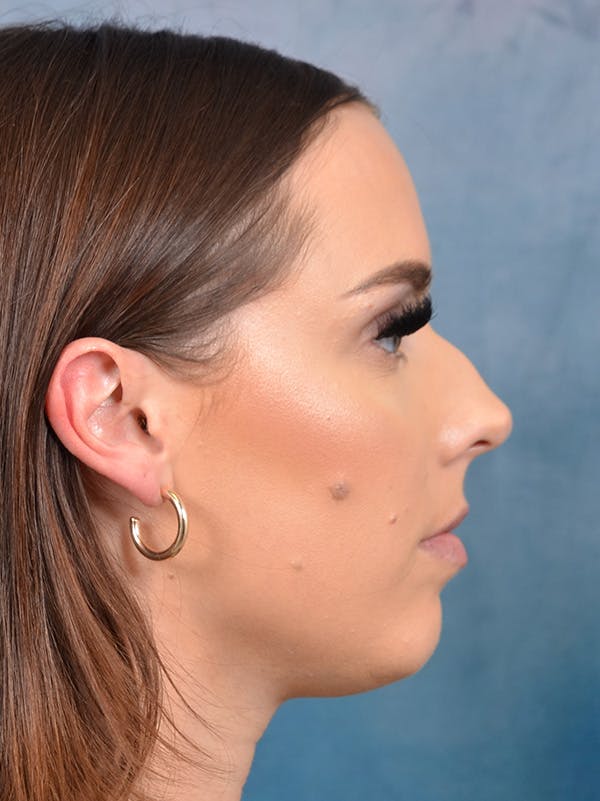 Rhinoplasty Before & After Gallery - Patient 148827476 - Image 7