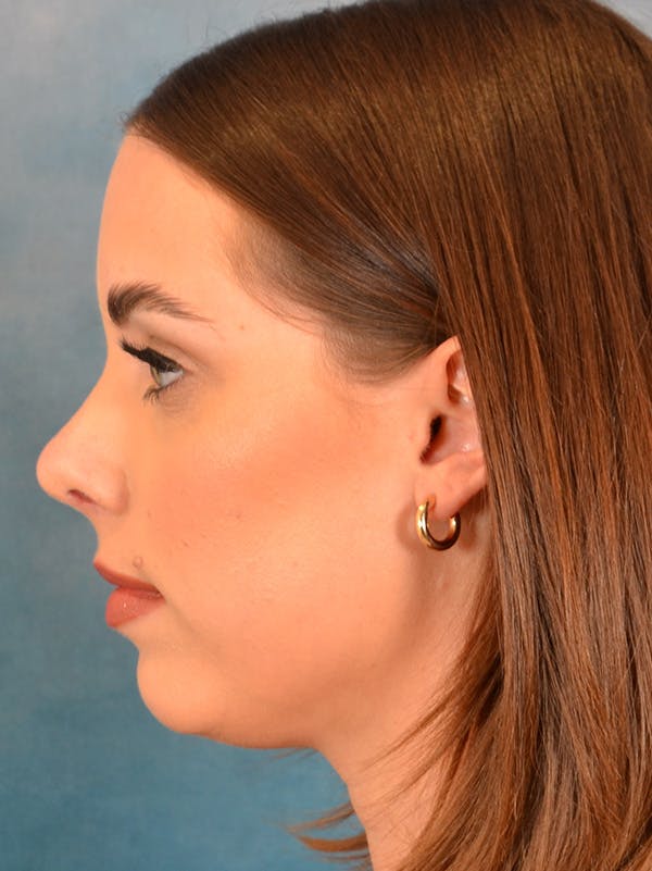 Rhinoplasty Before & After Gallery - Patient 148827476 - Image 2