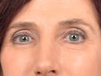 Eyelid Lift Before & After Gallery - Patient 148257057 - Image 1