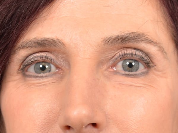 Brow Lift Before & After Gallery - Patient 148827551 - Image 1