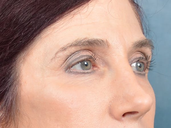 Eyelid Lift Before & After Gallery - Patient 148257057 - Image 3