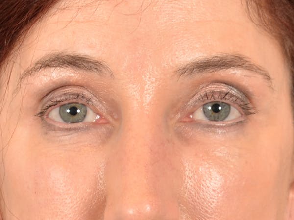 Eyelid Lift Before & After Gallery - Patient 148257057 - Image 2