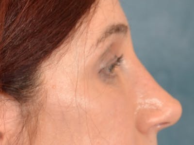 Eyelid Lift Before & After Gallery - Patient 148257057 - Image 6