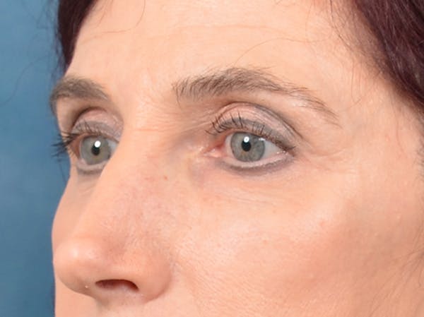 Eyelid Lift Before & After Gallery - Patient 148257057 - Image 7