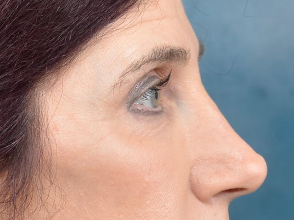 Eyelid Lift Before & After Gallery - Patient 148257057 - Image 5