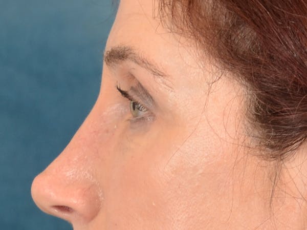 Brow Lift Before & After Gallery - Patient 148827551 - Image 10