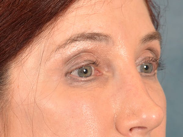 Eyelid Lift Before & After Gallery - Patient 148257057 - Image 4