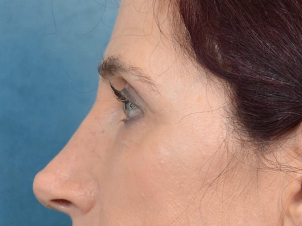Eyelid Lift Before & After Gallery - Patient 148257057 - Image 9