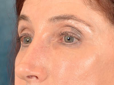 Eyelid Lift Before & After Gallery - Patient 148257057 - Image 8