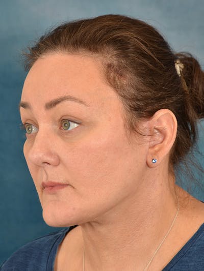 Deep Plane Facelift Before & After Gallery - Patient 148827530 - Image 2