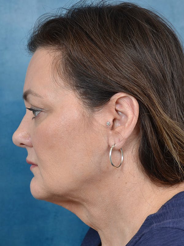 Deep Plane Facelift Before & After Gallery - Patient 148827530 - Image 3