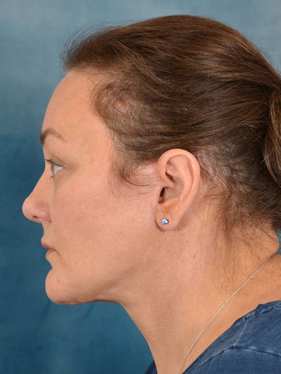 Deep Plane Facelift Before & After Gallery - Patient 148827530 - Image 4