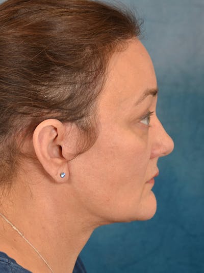 Deep Plane Facelift Before & After Gallery - Patient 148827530 - Image 10