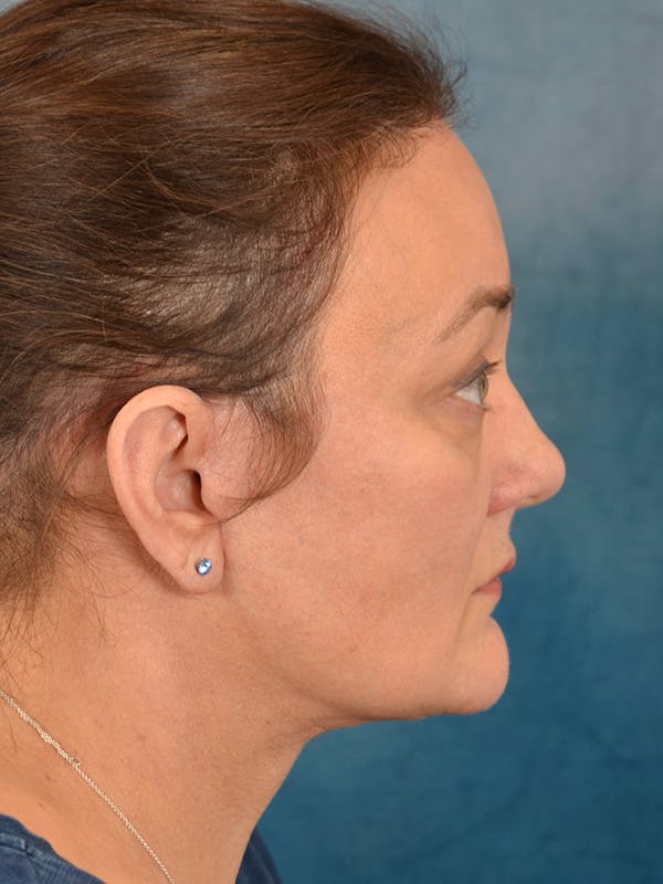 Deep Plane Facelift Before & After Gallery - Patient 148827530 - Image 10