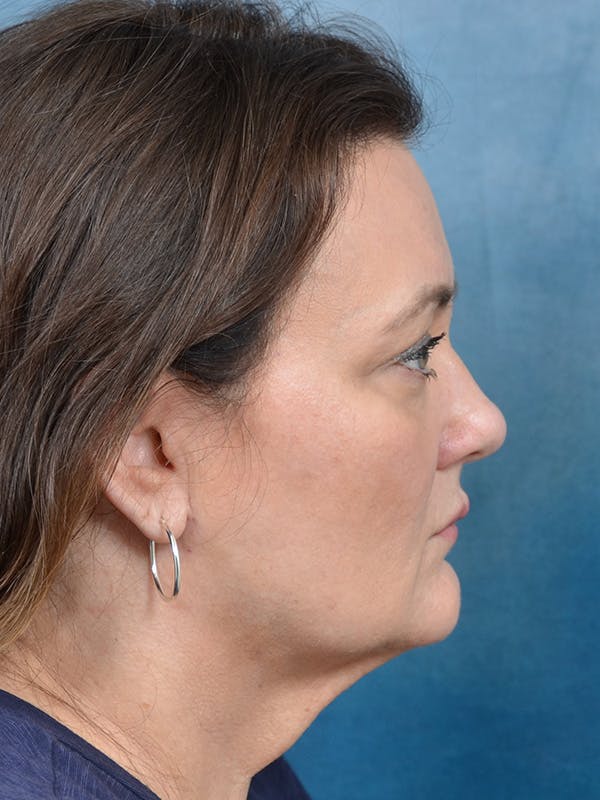 Deep Plane Facelift Before & After Gallery - Patient 148827530 - Image 9