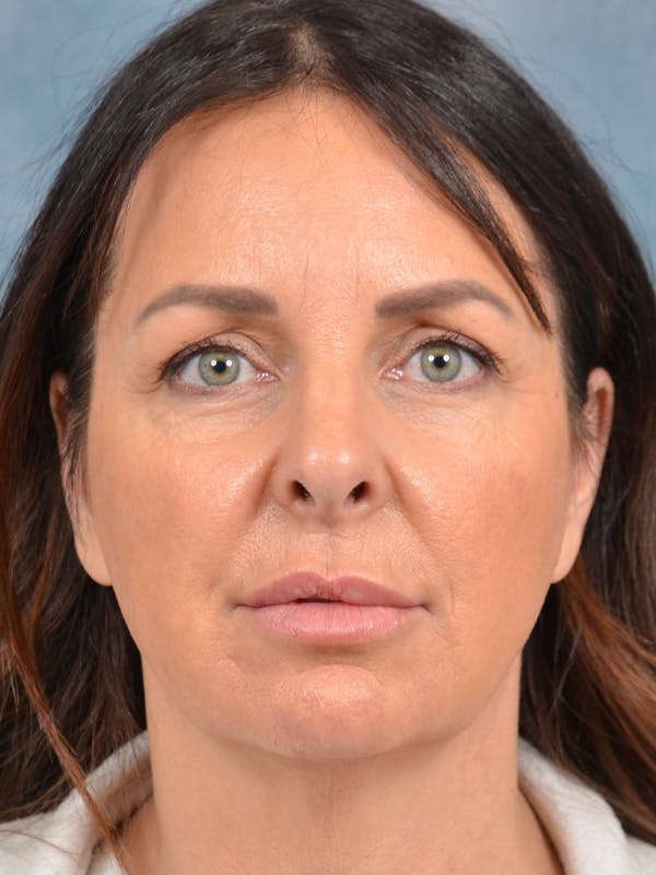 Brow Lift Before & After Gallery - Patient 148827532 - Image 1