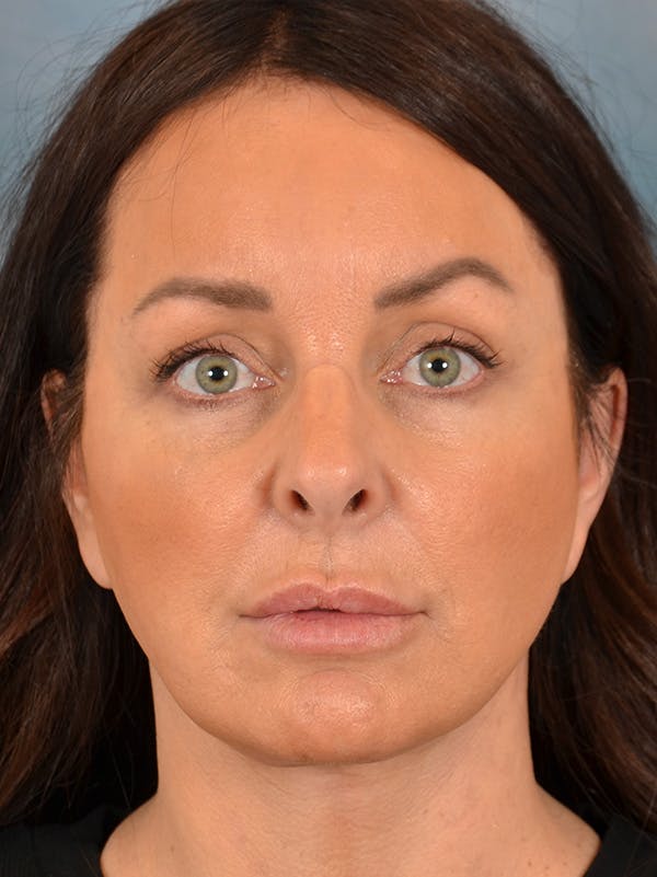 Deep Plane Facelift Before & After Gallery - Patient 148072052 - Image 4