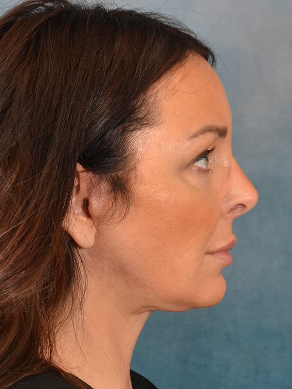 Deep Plane Facelift Before & After Gallery - Patient 148072052 - Image 8